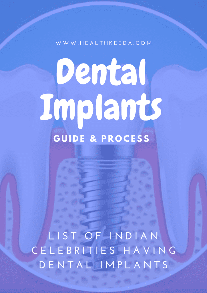 Dental Implants | Celebrities having Dental Implants