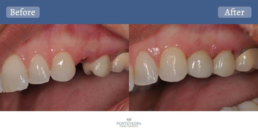 Dental Implants Before and After Photo