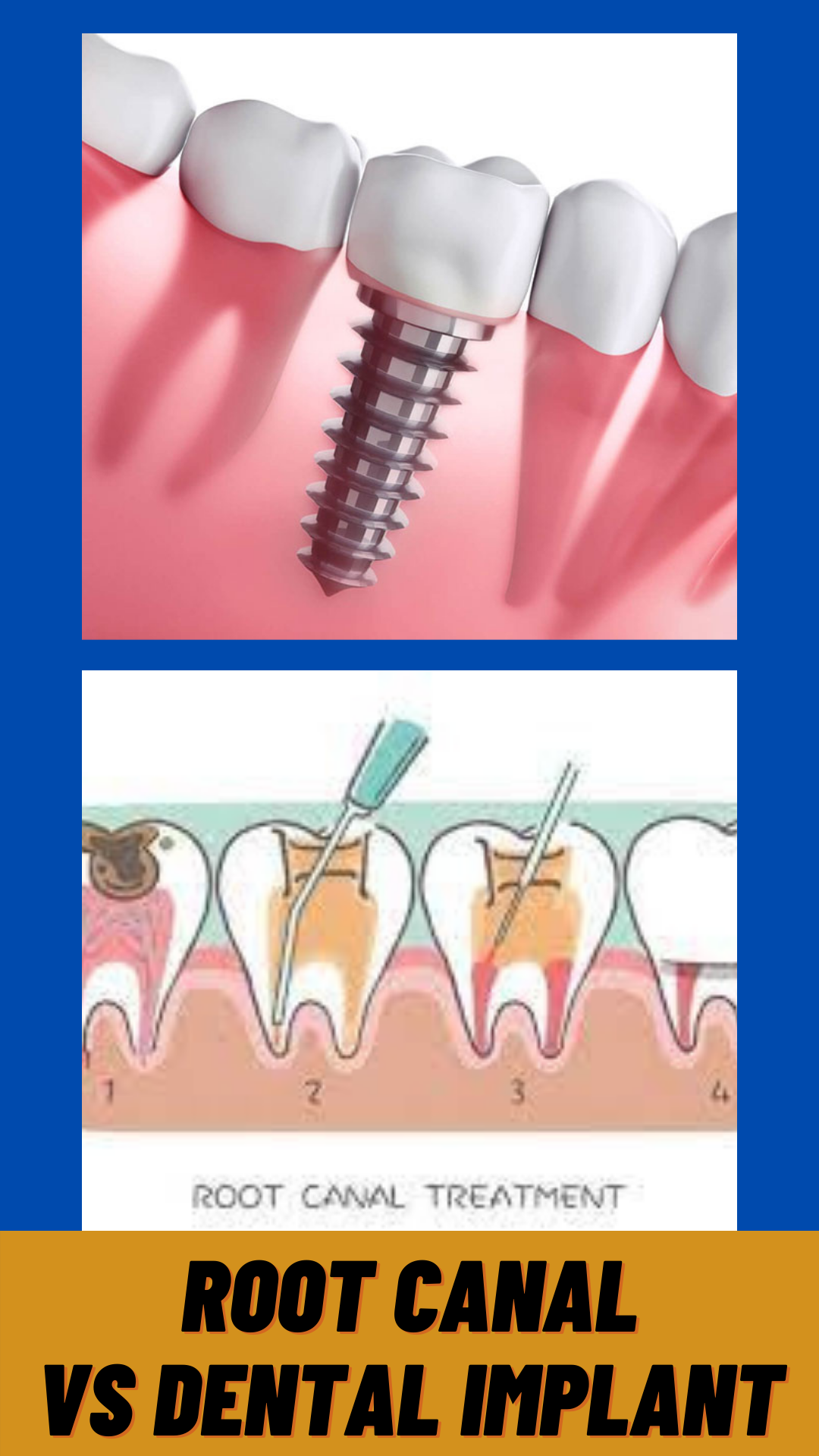 root canal vs dental implant